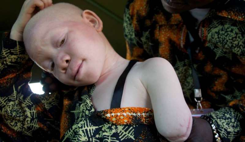 Albini africani, il massacro di cui nessuno parla