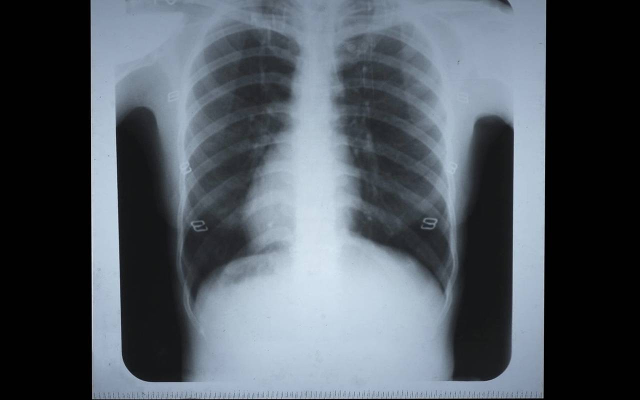 Covid-19, Spallanzani: dopo virus, restano danni polmonari