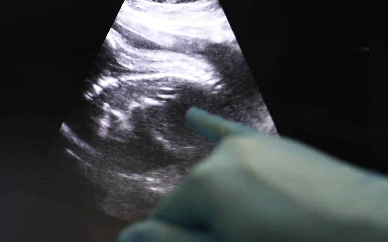 Bambin Gesù: raro intervento in utero su feto di 28 settimane -VIDEO –