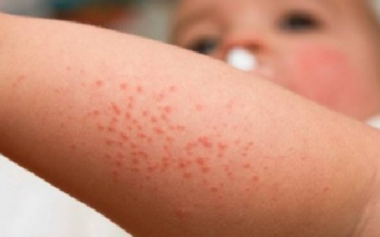 Con dermatite atopica, cresce il rischio di sviluppare ansia