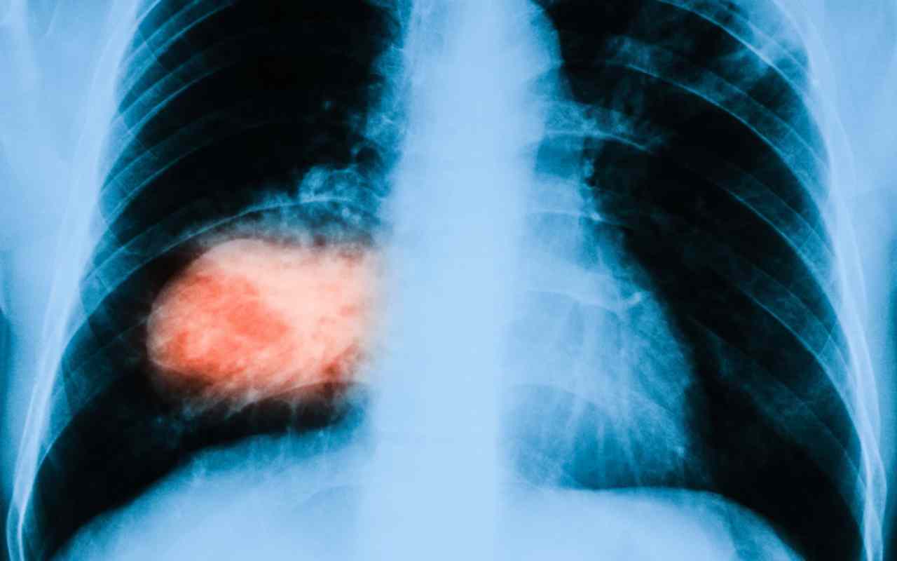 Cura del tumore al polmone: dagli Usa speranza per un nuovo farmaco