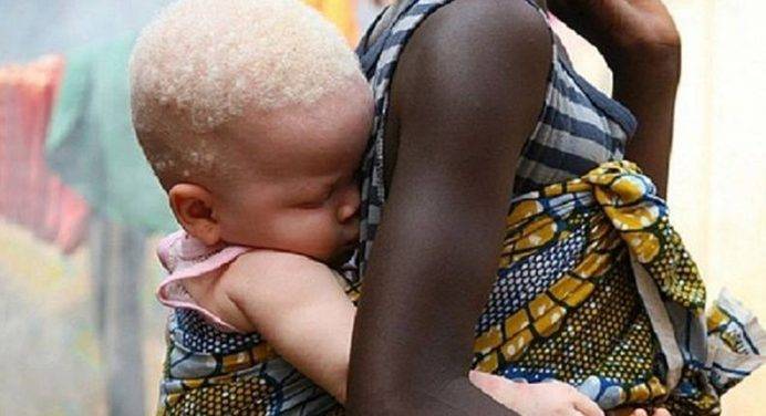 Albini a rischio discriminazione in Africa