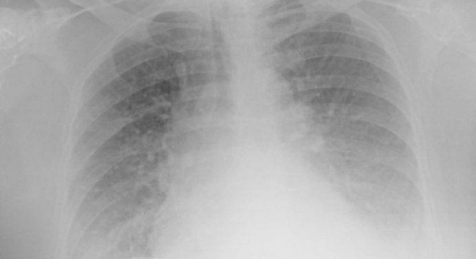 Un’ecografia ai polmoni può prevedere se i pazienti Covid si aggraveranno