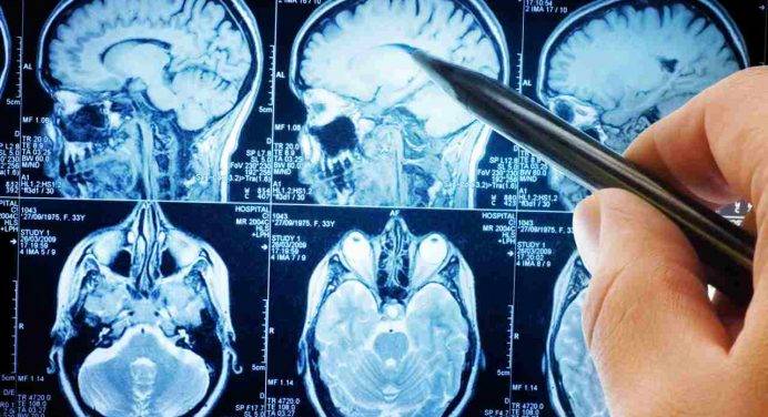 Intelligenza artificiale per una diagnosi “fast” del tumore al cervello