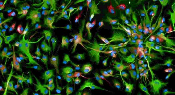 Nuove speranze di cura dalle CAR-T per i tumori cerebrali dei bambini