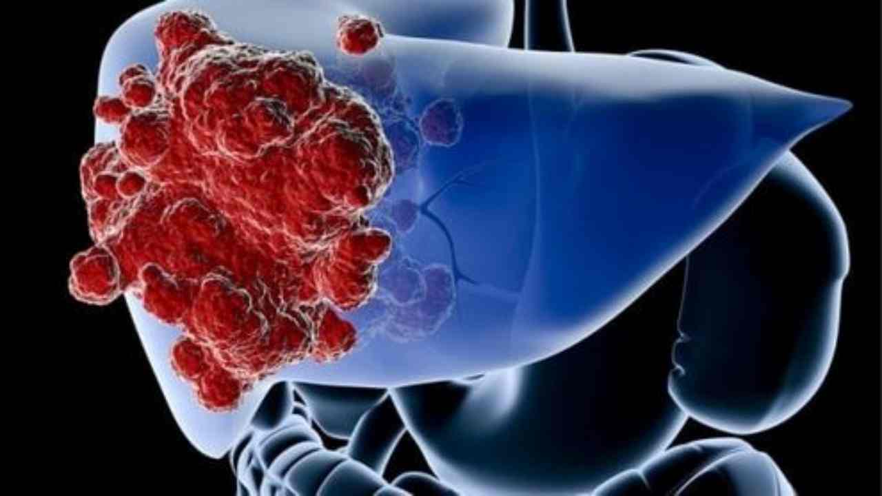 Epatocarcinoma: nuovo approccio terapeutico per il tumore al fegato