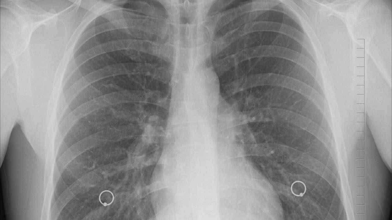 Covid, in aumento i casi di polmonite: il responsabile è Omicron BA.5