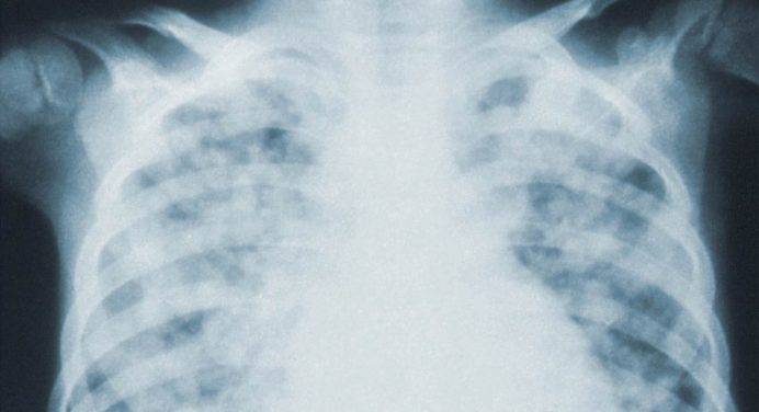 Lo studio: 8mila morti l’anno per polmonite, rischi maggiori per gli anziani