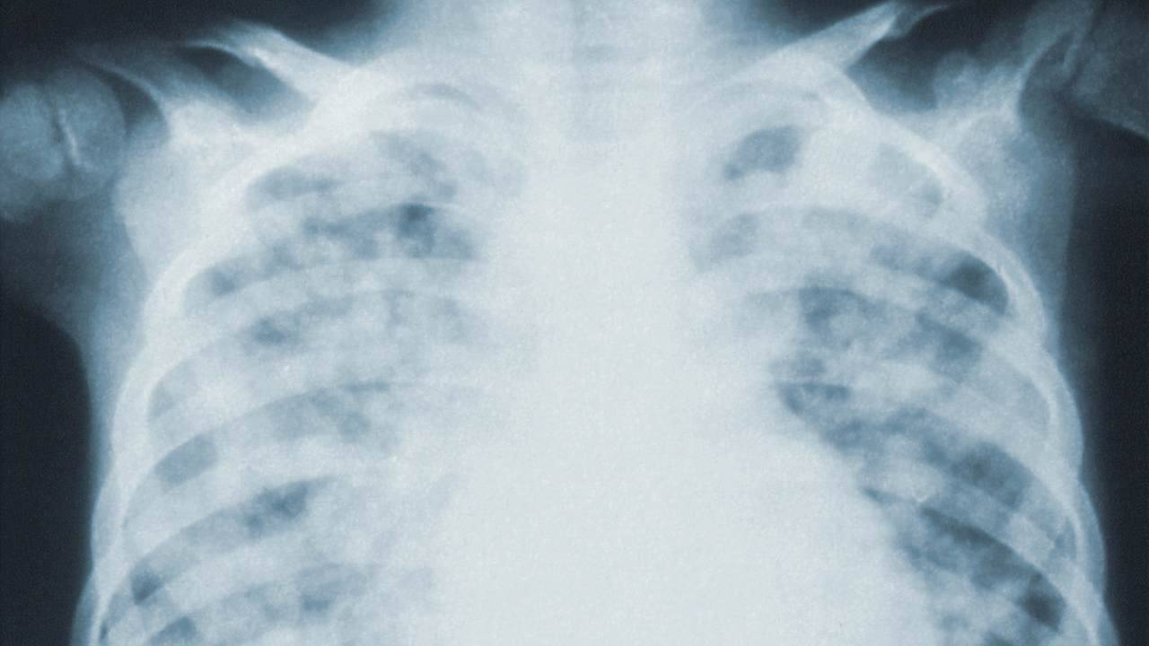 Vaia: “In Italia nessuna preoccupazione per le polmoniti pediatriche”